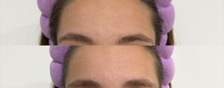 Silikonová náplast Nua – krk